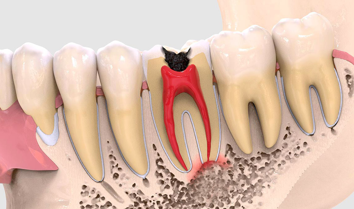 Хлоргексидин и желтые зубы – какая связь – советы стоматологов